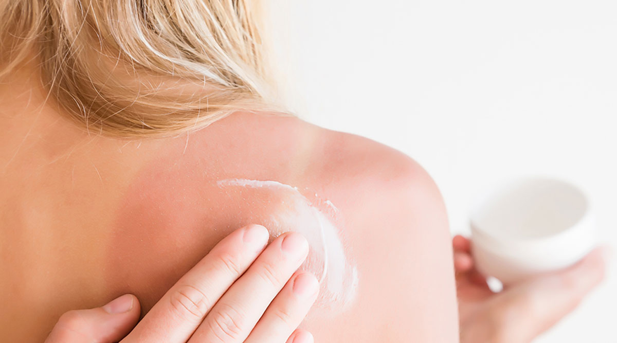 vrouw met verbrande schouder wordt ingesmeerd met een zalfje