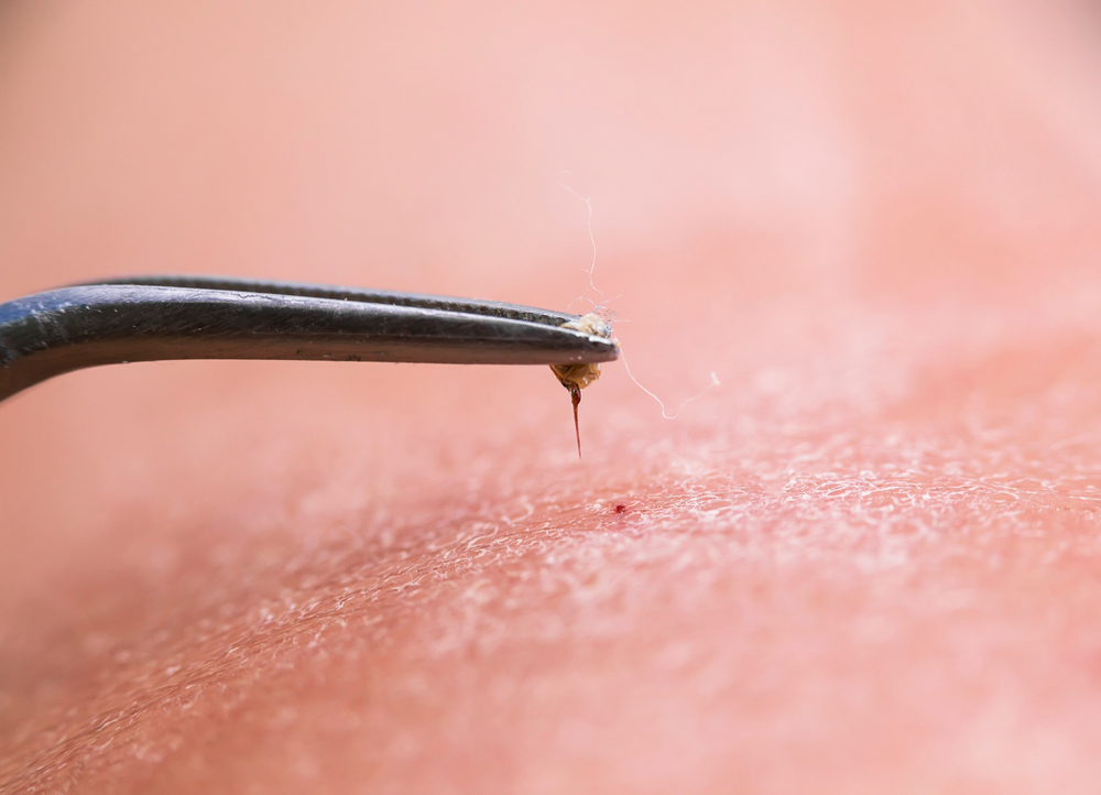 angel van een bij verwijderen met een pincet